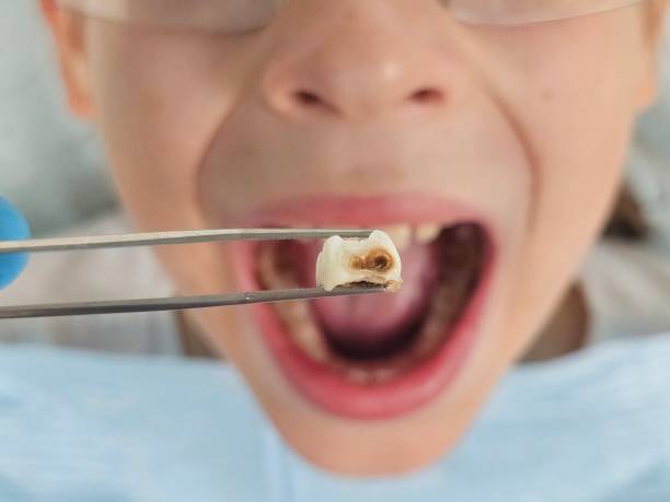 Best Dentist for Tooth Abscess  in Powell, AL